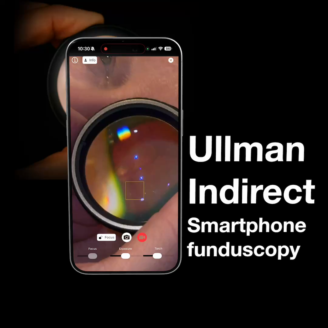 Indirect Ophthalmoscopy Feature